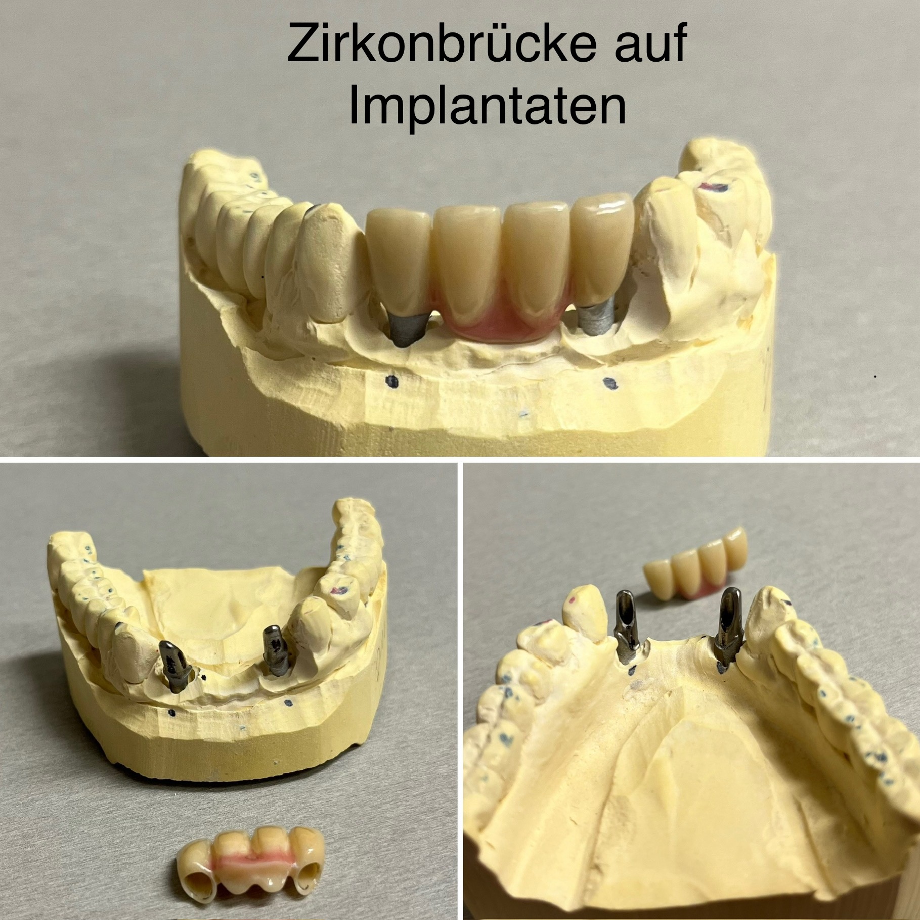 Zirkonbrücke auf Implantaten