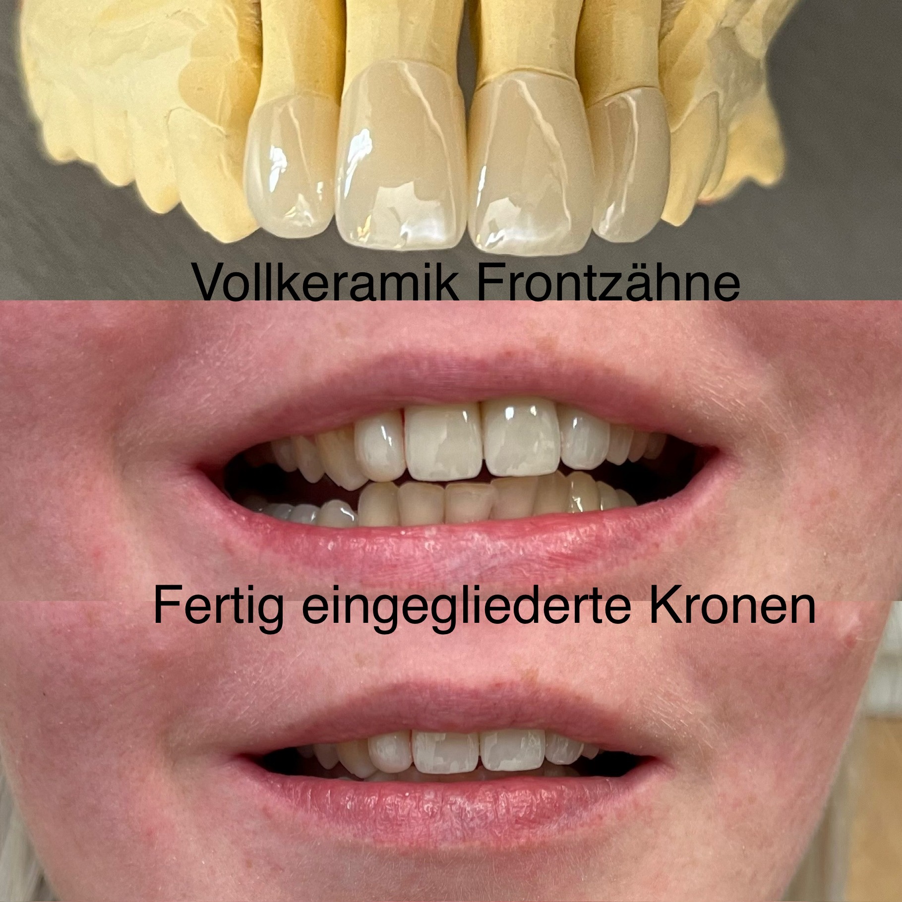 Frontzahnkronen eingegliedert