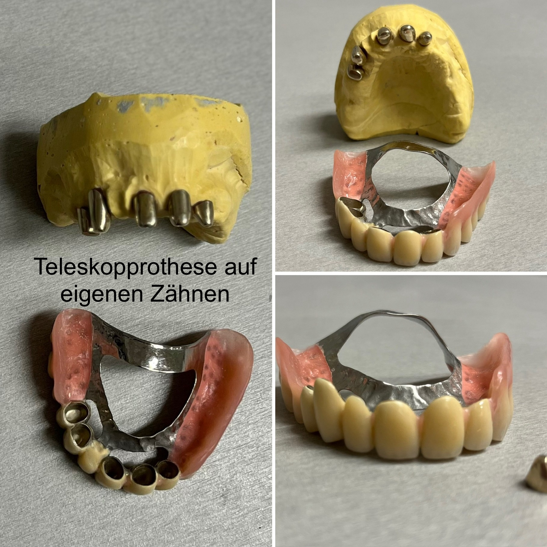 Teleskopprothese auf eigenen Zähnen