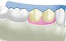 Kompositfüllungen (Dentinadhäsive Rekonstruktionen)